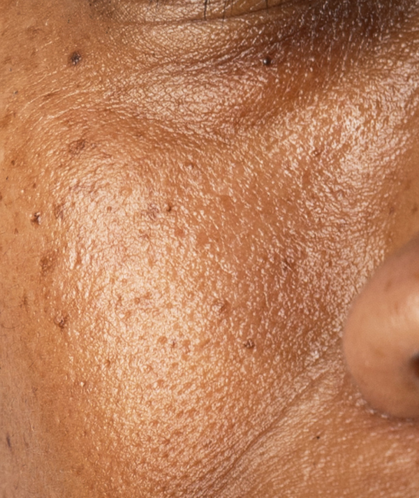 Hyperpigmentation